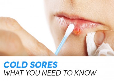Cold Sores - What causes them and how to treat them.