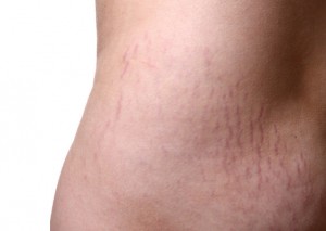Do your stretch marks bother you?